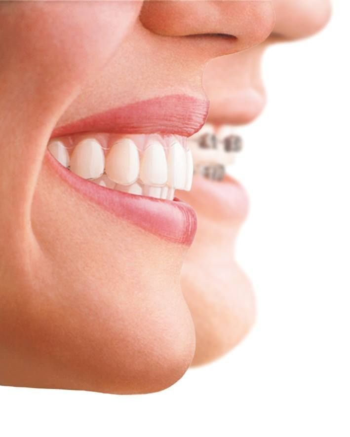 Cosmetic Tooth Alignment